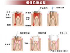 牙烂到什么程度要根管治疗,什么情况下需要做根管治疗