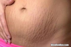 妊娠纹为什么会痒,为什么肚子的妊娠纹会痒
