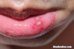 口腔溃疡是因为什么,口腔溃疡是由什么原因引起的？